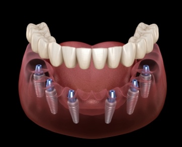 Illustrated denture being fitted onto six dental implants