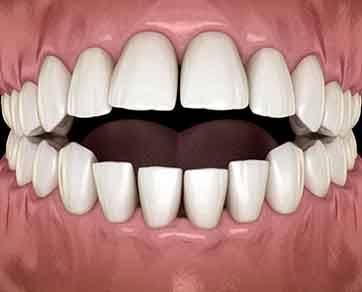Illustration of teeth with crossbite