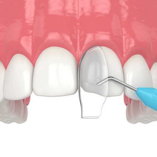 Illustration of cosmetic dental bonding in Fort Worth, TX