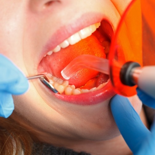 Close up of woman getting cosmetic dental bonding in Fort Worth