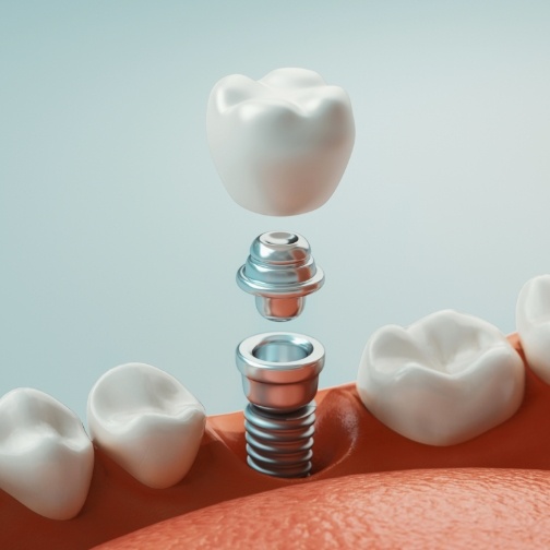 Illustrated dental implant in Fort Worth being placed in lower jaw