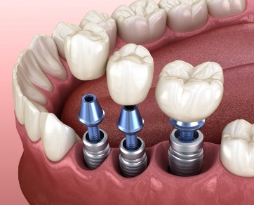 Illustration of three dental crowns being fitted onto three dental implants