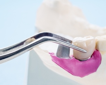 Tweezers placing a dental crown on a dental implant model