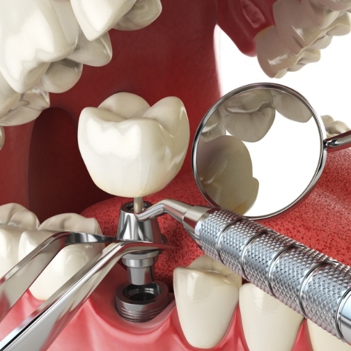 Illustrated dental implant with crown being placed in lower jaw