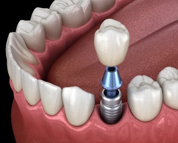 Illustrated dental crown being fitted onto a dental implant