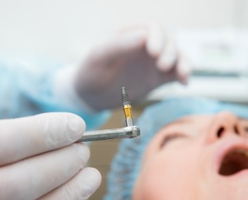 Dentist holding a dental implant right before placing it in a patients mouth