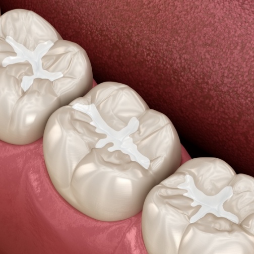 Illustrated row of teeth with dental sealants in Fort Worth