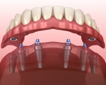 Illustration of implant denture being placed onto six dental implants