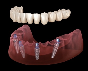 Illustrated All on 4 denture being placed onto four dental implants