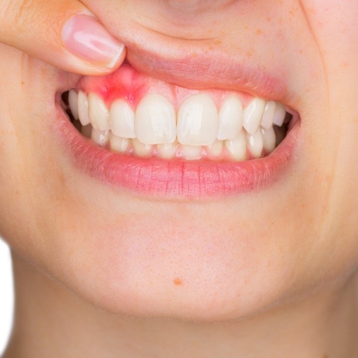 Close up of person pointing to red spot in their gums before gum disease treatment