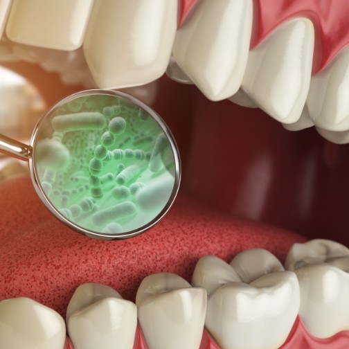Illustrated dental mirror zooming into mouth showing green bacteria
