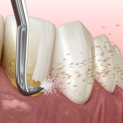 Illustrated dental scaler clearing plaque buildup from teeth