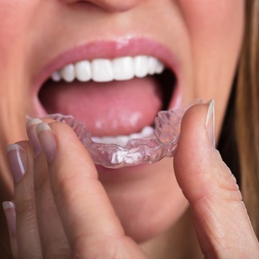 Close up of woman placing a nightguard over her lower teeth
