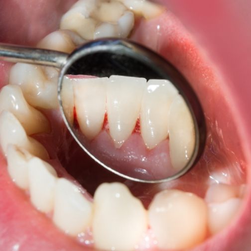 Close up of dental mirror reflecting tooth inside mouth