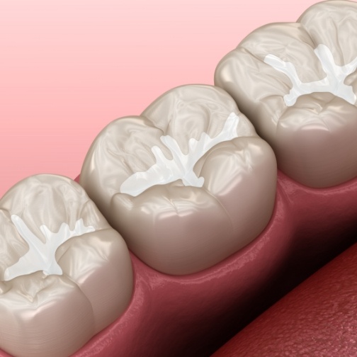 Illustrated row of teeth with dental sealants