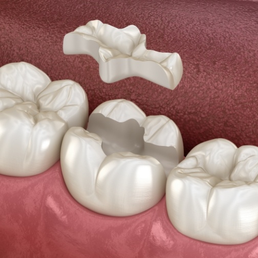 Illustrated dental inlay being placed onto a broken tooth