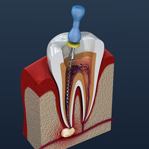 Illustration of a root canal treatment in Fort Worth, TX 