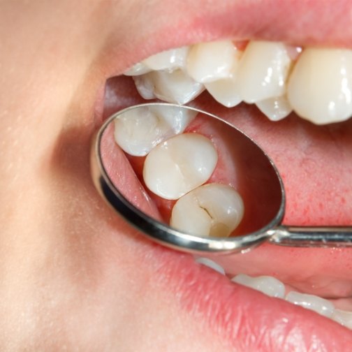 Close up of dental mirror in mouth reflecting tooth