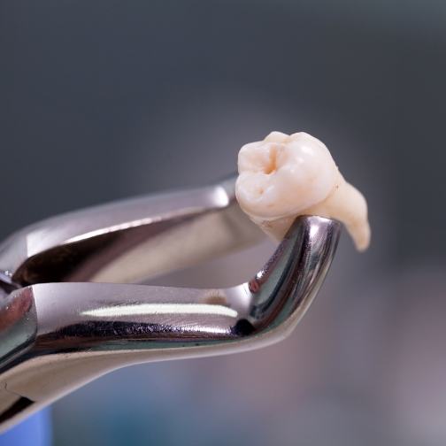 Dental clasp holding an extracted tooth