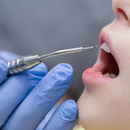 Dentist using a dental laser