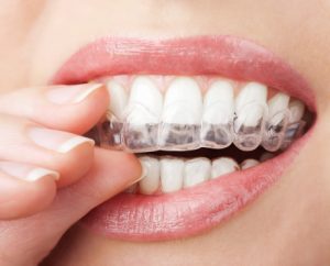 Blue Dot indicators track patient compliance with Invisalign aligners