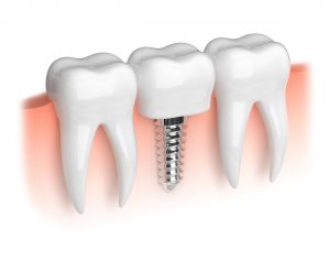 Model of dental implant and crown.