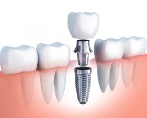 An image of a dental implant.