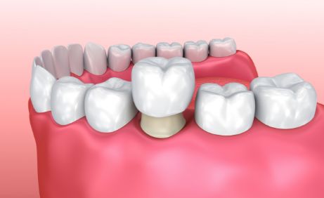 3D image of a dental crown on a lower tooth