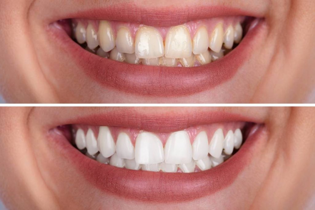 How Does Teeth Whitening Work and Can It Cause Sensitivity?