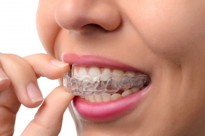 an up-close look at a woman inserting an Invisalign aligner into her mouth