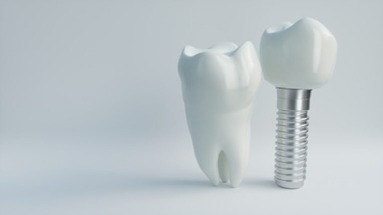 Myths About Dental Implants Fort Worth Dentist Distinguished Dental