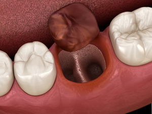 Illustration of a dry socket with dislodged blood clot nearby